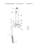 REMOVAL OF PROSTHESES diagram and image