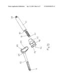 REMOVAL OF PROSTHESES diagram and image