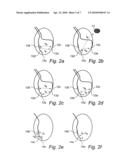 MEDICAL DEVICE FOR DETECTING ISCHEMIA AND A METHOD FOR SUCH A DEVICE diagram and image