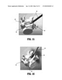 SWELLABLE INTERSPINOUS STABILIZATION IMPLANT diagram and image