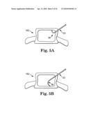 METHOD AND STRUCTURE FOR STABILIZING A VERTEBRAL BODY diagram and image