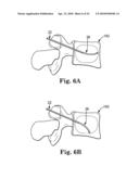 METHOD AND STRUCTURE FOR STABILIZING A VERTEBRAL BODY diagram and image