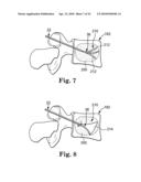 METHOD AND STRUCTURE FOR STABILIZING A VERTEBRAL BODY diagram and image