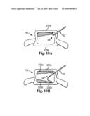 METHOD AND STRUCTURE FOR STABILIZING A VERTEBRAL BODY diagram and image