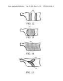 METHOD AND STRUCTURE FOR STABILIZING A VERTEBRAL BODY diagram and image