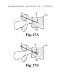 METHOD AND STRUCTURE FOR STABILIZING A VERTEBRAL BODY diagram and image