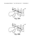 METHOD AND STRUCTURE FOR STABILIZING A VERTEBRAL BODY diagram and image