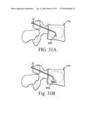 METHOD AND STRUCTURE FOR STABILIZING A VERTEBRAL BODY diagram and image