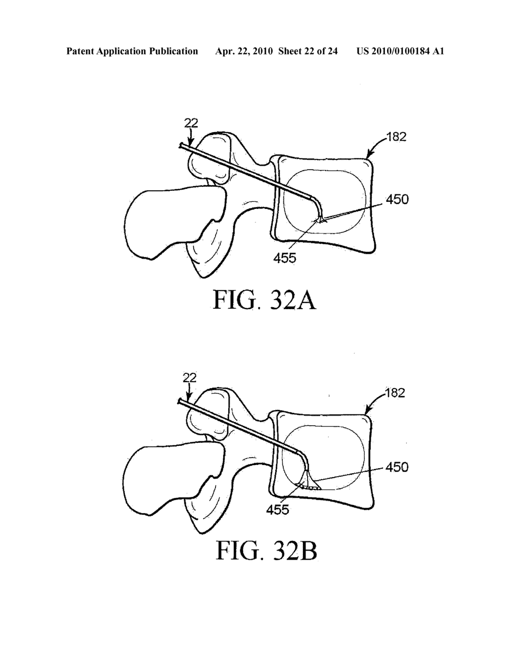 METHOD AND STRUCTURE FOR STABILIZING A VERTEBRAL BODY - diagram, schematic, and image 23