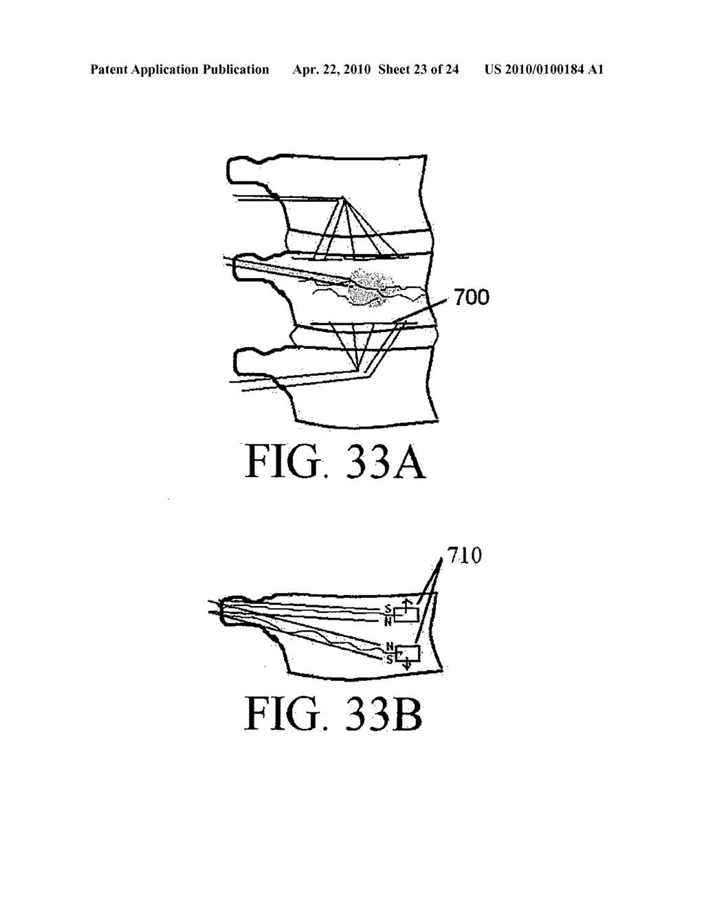 METHOD AND STRUCTURE FOR STABILIZING A VERTEBRAL BODY - diagram, schematic, and image 24