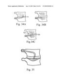 METHOD AND STRUCTURE FOR STABILIZING A VERTEBRAL BODY diagram and image