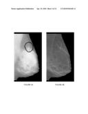 METHOD AND APPARATUS FOR DETECTING SPICULATED MASSES IN MAMMOGRAPHY diagram and image