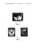 Methods of treating Parkinson s disease using viral vectors diagram and image