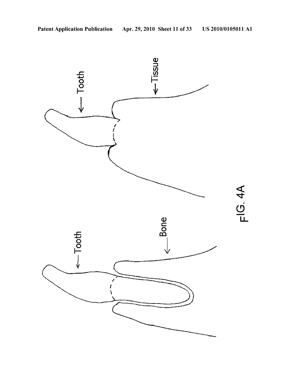 System, Method And Apparatus For Tooth Implant Planning And Tooth Implant Kits - diagram, schematic, and image 12