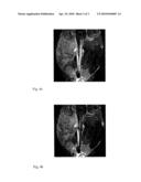 DOUBLE-CONTRAST TECHNIQUE FOR MRI-GUIDED VASCULAR INTERVENTIONS diagram and image