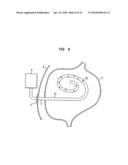 METHOD FOR TREATING OBESITY BY EXTRACTING FOOD diagram and image