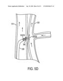 TRANSCAVAL MESENTERIC VENOUS ANASTOMOSIS AND ACCESS SYSTEM diagram and image