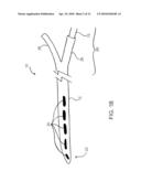 DEVICES, SYSTEMS, AND METHODS FOR ENDOSCOPIC GASTRIC MAGNETIC RESTRICTION diagram and image