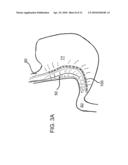 DEVICES, SYSTEMS, AND METHODS FOR ENDOSCOPIC GASTRIC MAGNETIC RESTRICTION diagram and image