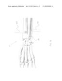 System and method for distal radioulnar joint resurfacing with dynamic fixation diagram and image