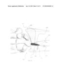 System and method for distal radioulnar joint resurfacing with dynamic fixation diagram and image