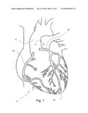 MEDICAL STENT diagram and image