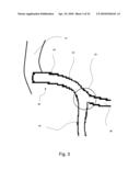 MEDICAL STENT diagram and image