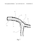 MEDICAL STENT diagram and image