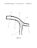 MEDICAL STENT diagram and image