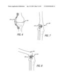 Extra-Articular Implantable Mechanical Energy Absorbing Systems diagram and image