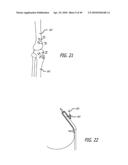 Extra-Articular Implantable Mechanical Energy Absorbing Systems diagram and image