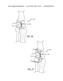 Extra-Articular Implantable Mechanical Energy Absorbing Systems diagram and image