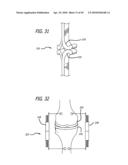 Extra-Articular Implantable Mechanical Energy Absorbing Systems diagram and image