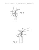 Extra-Articular Implantable Mechanical Energy Absorbing Systems diagram and image