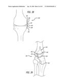 Extra-Articular Implantable Mechanical Energy Absorbing Systems diagram and image