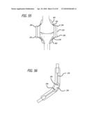 Extra-Articular Implantable Mechanical Energy Absorbing Systems diagram and image