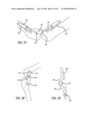 Extra-Articular Implantable Mechanical Energy Absorbing Systems diagram and image