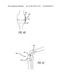 Extra-Articular Implantable Mechanical Energy Absorbing Systems diagram and image