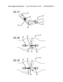 Extra-Articular Implantable Mechanical Energy Absorbing Systems diagram and image