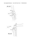 Extra-Articular Implantable Mechanical Energy Absorbing Systems diagram and image