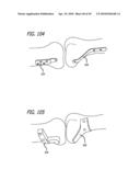 Extra-Articular Implantable Mechanical Energy Absorbing Systems diagram and image