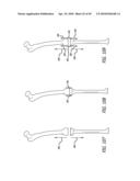 Extra-Articular Implantable Mechanical Energy Absorbing Systems diagram and image