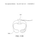 VENTILATOR MASK AND SYSTEM diagram and image