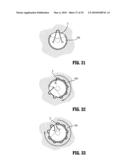 SURGICAL STAPLER diagram and image