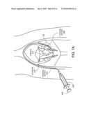 EMBOLIZATION diagram and image