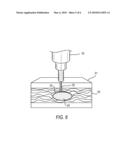 FLOWABLE COMPOSITION THAT HARDENS ON DELIVERY TO A TARGET TISSUE SITE BENEATH THE SKIN diagram and image