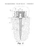 Dental implant system diagram and image