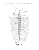 Dental implant system diagram and image