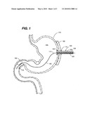 Gastrostomy-jejunostomy tube apparatus and method for endoscopically placing same within a patient diagram and image