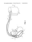 SYSTEM AND METHOD TO LOCALIZE CHANGES IN INTRATHORACIC FLUID CONTENT USING MEASURED IMPEDANCE IN AN IMPLANTABLE DEVICE diagram and image